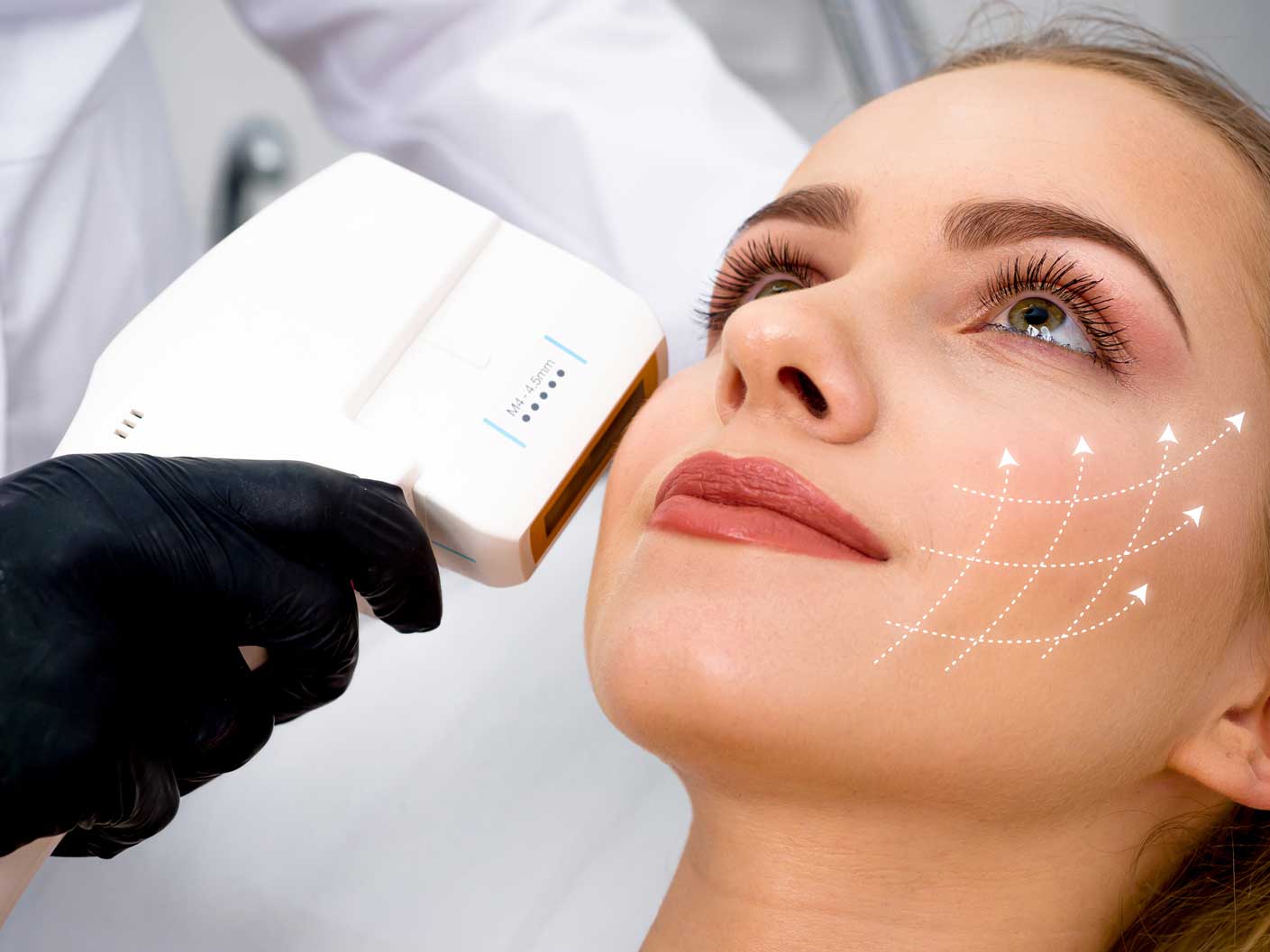 HIFU facial